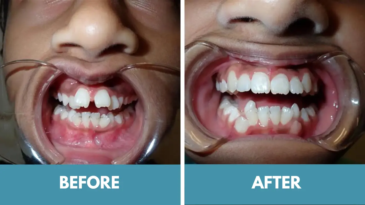 overcrowding-SD overcrowding treatment with retainers