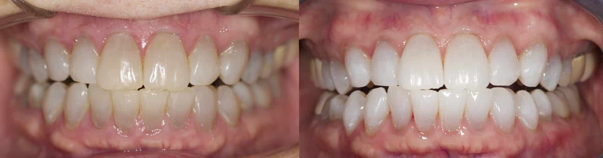 teeth whitening results